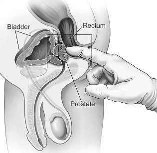 treatment of prostatitis in house massage