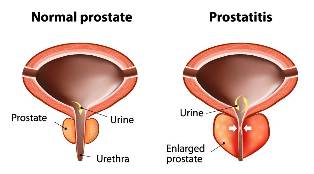 acute prostatitis treatment